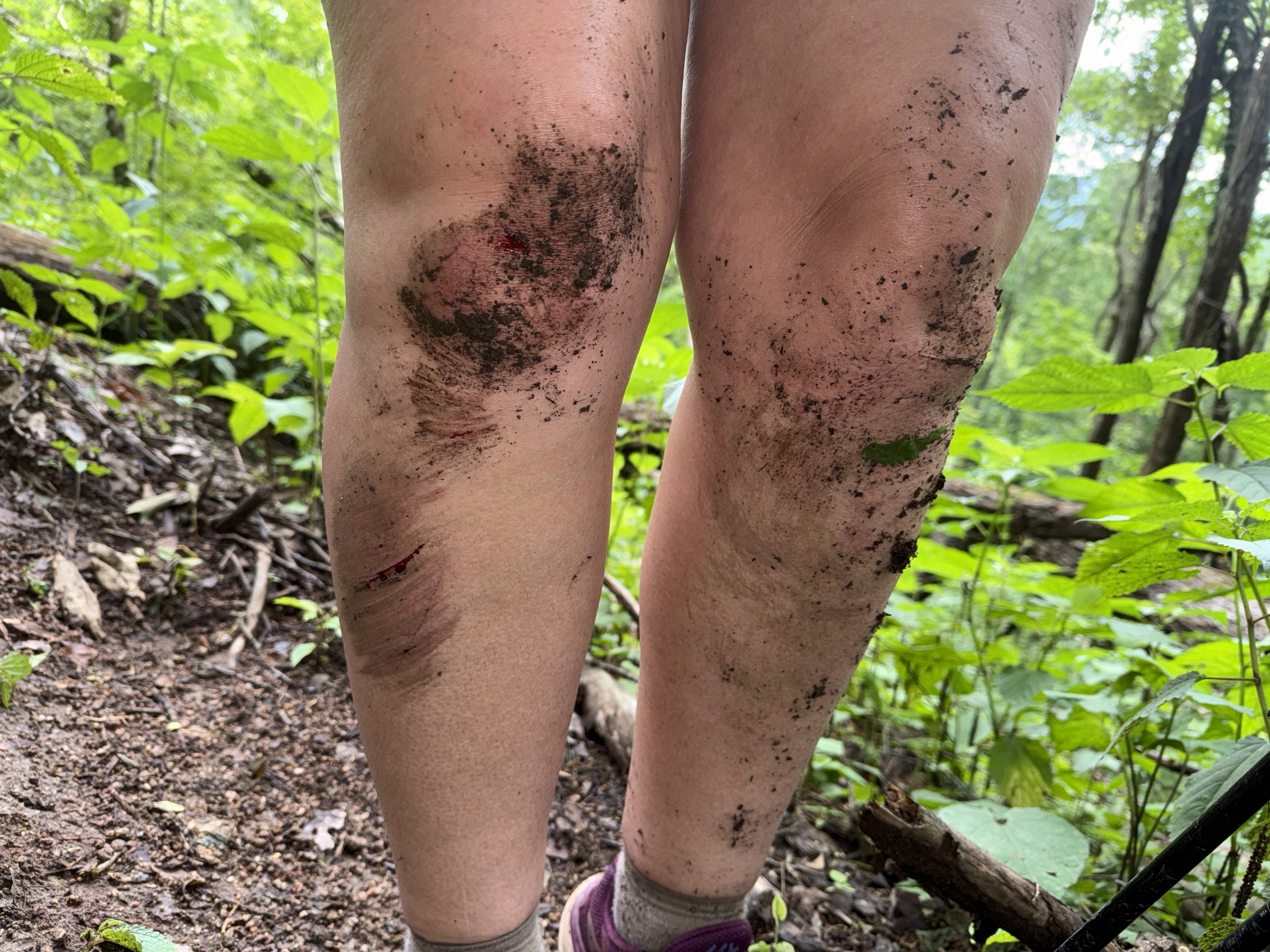 Appalachian Trail Day 36: First Injury